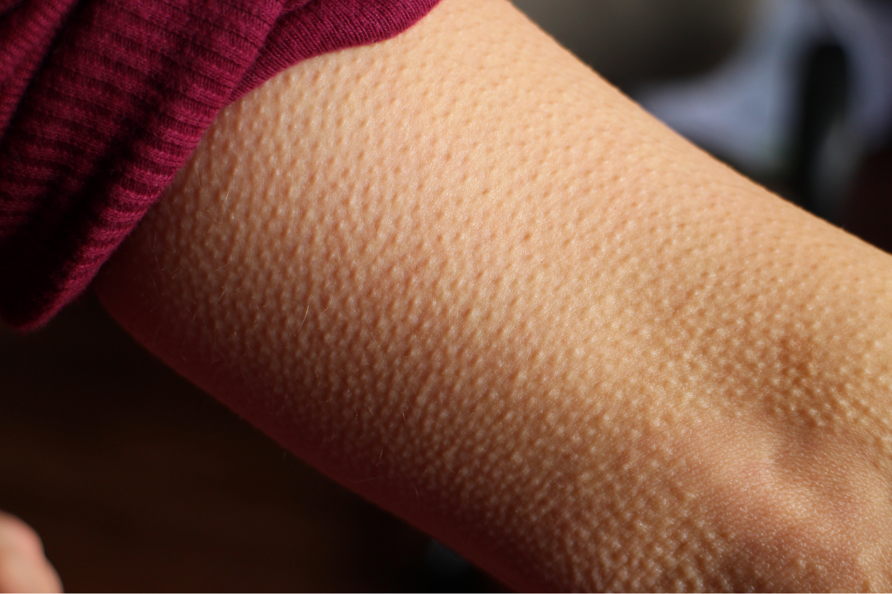 Goosebumps